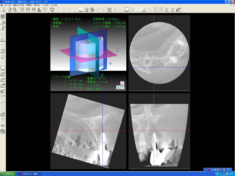 3D・パノラマX線装置　ベラビューエポックス3DのCT画像